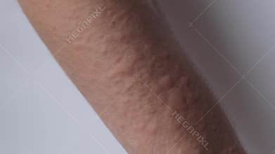 Rash on the arm, urticaria, allergies, skin diseases of a large clan. Papules, pimples.
