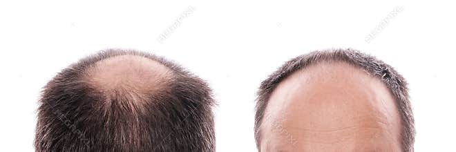 Hair loss