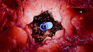 inflammatory bowel Disease traitement, Colorectal cancer, Endoscope colonoscopy, capsule, pill