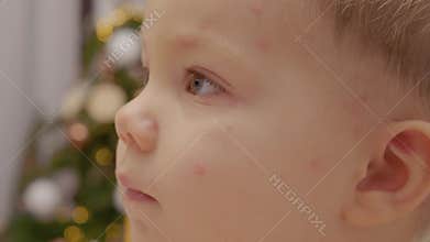 Child with chickenpox showing symptoms close up in home setting