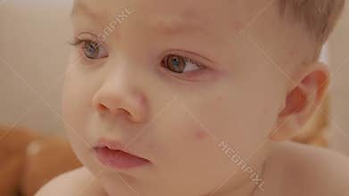Child showing symptoms of chickenpox with close-up shots of face and eyes