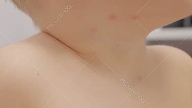 Child shows early signs of chickenpox on chest and neck in home setting