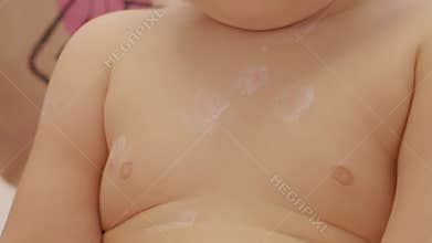 Child with chickenpox receives ointment treatment for red sores at home