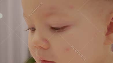 Child with chickenpox shows symptoms in close-up view of face and eyes