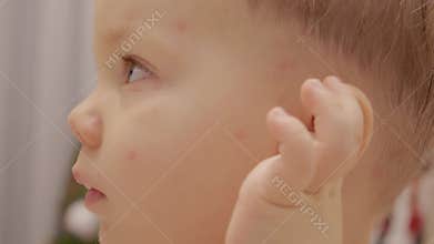 Child with early stage chickenpox shows signs of itching and discomfort
