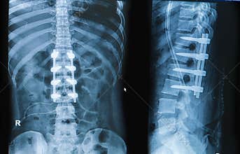 X-ray image of back pain show spinal column with implant fusion