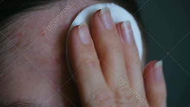 Woman cleaning problematic skin with cotton pad