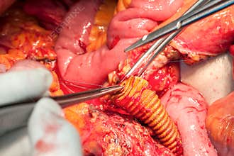Abdomen arteries and veins with prosthesis