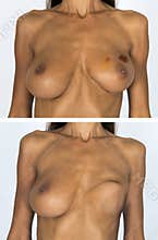 Breast Cancer Survivor mastectomy Before and After