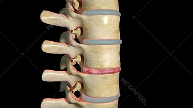 Spondylolisthesis overview
