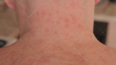 The hairy back and neck of an adult male with pimples from chickenpox.