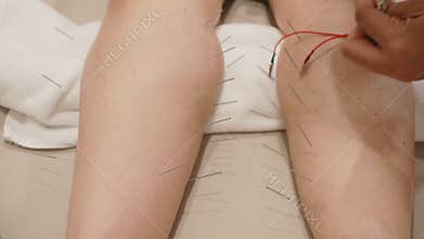 Acupuncture treatment on woman leg