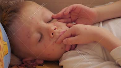 Little boy with chickenpox is lying on the bed with lot of blisters on his skin.