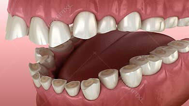 Dental attrition Bruxism resulting in loss of tooth tissue.  Medically accurate tooth 3D animation