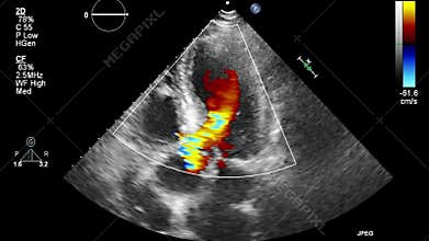 Ultrasound transesophageal examination of the heart.