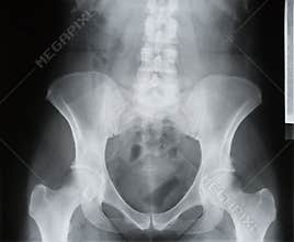 Backbone, pelvis, socket of hip joint, thigh bone x-ray, osteoporosis