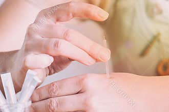 Hand applying acupuncture needle