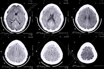 Ct scan brain