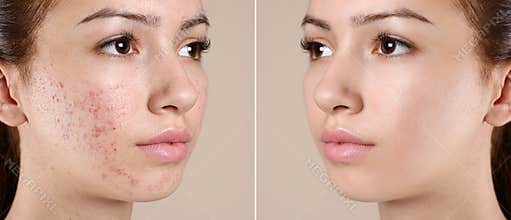 Teenage girl before and after acne treatment on background