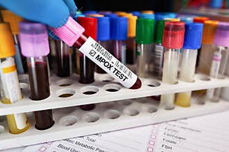 Doctor holding blood tube for MPOX Monkeypox disease test