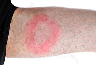 Lyme disease, bacterial infection