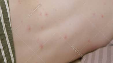 A closeup image depicting a skin condition chickenpox featuring noticeable red bumps and spots
