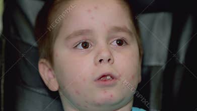 A captivating and expressive portrait of a child with a skin condition chickenpox that conveys emotion
