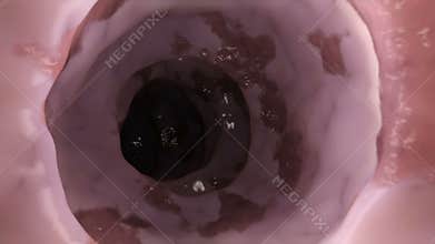 Ill colon
