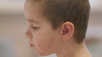 A child with a skin condition chickenpox is shown in profile, highlighting their unique features