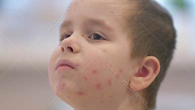 A thoughtful child living with a skin condition chickenpox captured in a soft focus environment