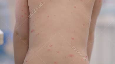 A back view of a child displaying skin rash chickenpox in a medical setting for examination
