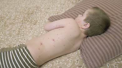 A child with a skin condition chickenpox is resting on a bed, surrounded by calmness to aid recovery