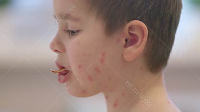 A Child with a Skin Condition chickenpox That Requires Care and Understanding from Parents and Doctors
