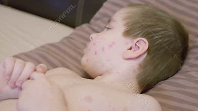 A Child Who Is Currently Experiencing a Skin Condition chickenpox Can Be Seen Resting Comfortably on Their Bed