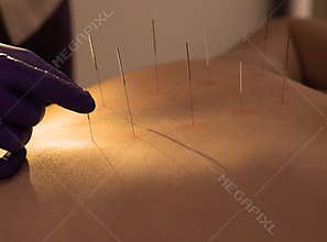Acupuncturist inserting needles into a female back. patient having traditional Chinese treatment using needles to restore an