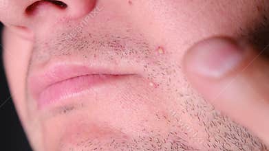 Close up of a man squeezing a pimple