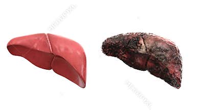 Healthy liver and disease liver on white isolate. Autopsy medical concept. Cancer and smoking problem.