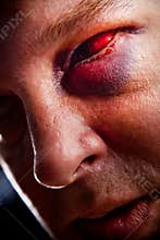 Black eye