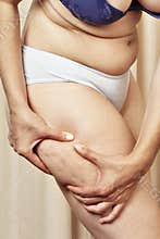 Cellulite