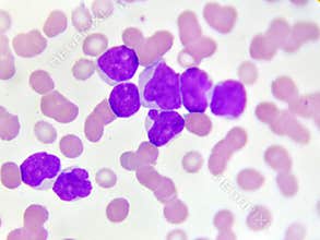 Acute myeloid leukemia