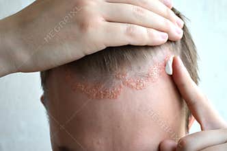 Anoint with cream, ointment, medicine forehead, hair line, scalp with psoriasis, dermatitis, problem skin, eczema