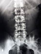 Lumbar spine x-ray, lower back