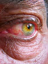 Wrinkled bloodshot eye