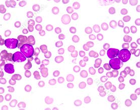 Acute myeloblastic leukemia(AML)