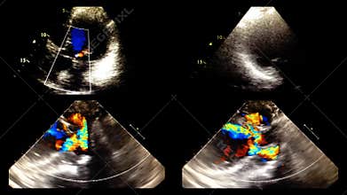 Echocardiography ultrasound examination of the heart