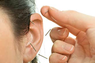 Acupuncture