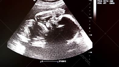 Video of monitor with ultrasound of a baby at 21 weeks