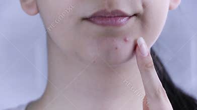 Skin care. A young woman looks at a pimple on her face. Skin treatment, beauty. Close up. Acne, redness, blemishes, blackheads, co