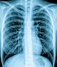 Chest Xray