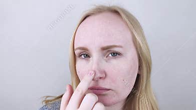 A woman examines dry skin on her face. Peeling, coarsening, discomfort, skin sensitivity. Patient at the appointment of a dermatol